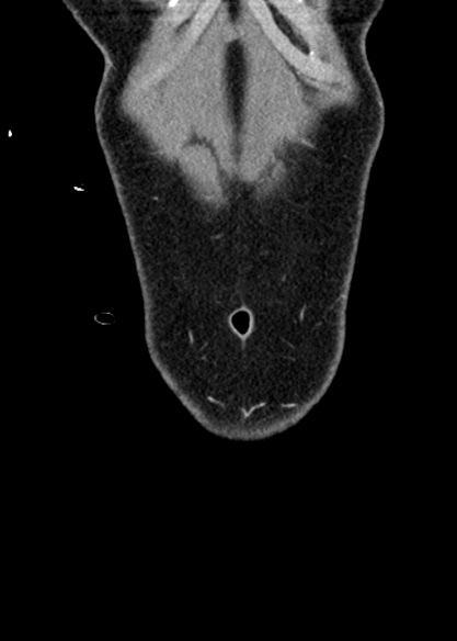 Adhesional small bowel obstruction (Radiopaedia 48397-53305 Coronal C+ portal venous phase 26).jpg