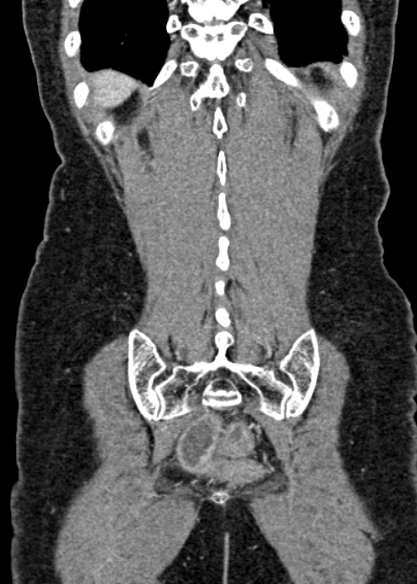 Adhesional small bowel obstruction (Radiopaedia 48397-53305 Coronal C+ portal venous phase 301).jpg