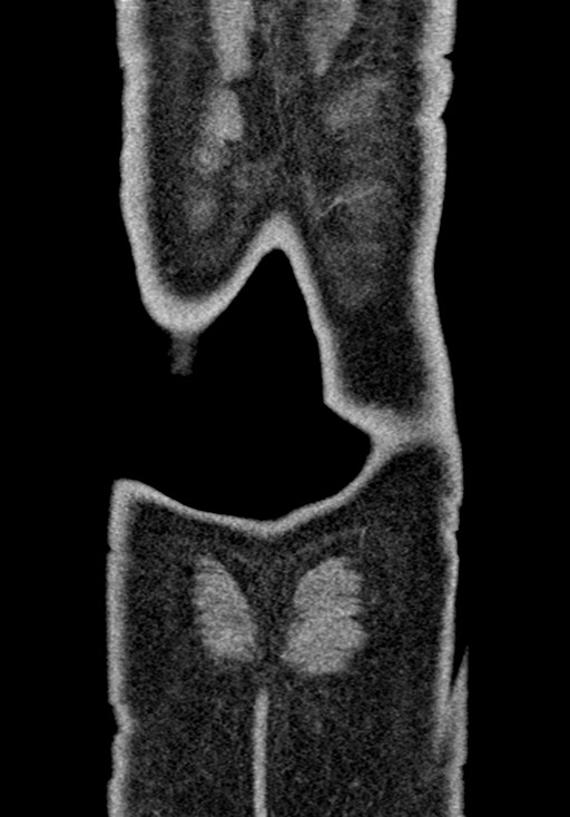 Adhesional small bowel obstruction (Radiopaedia 58900-66131 Coronal C+ portal venous phase 234).jpg