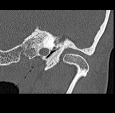 File:Adhesive chronic otitis media (Radiopaedia 14270-14148 Coronal bone window - left 7).jpg