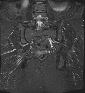File:Adnexal multilocular cyst (O-RADS US 3- O-RADS MRI 3) (Radiopaedia 87426-103754 Coronal T2 fat sat 24).jpg