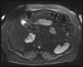 File:Adrenal cortical carcinoma (Radiopaedia 64017-72770 Axial DWI 55).jpg