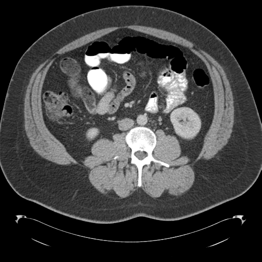 File:Adrenal cyst (Radiopaedia 45625-49776 Axial C+ portal venous phase 51).png