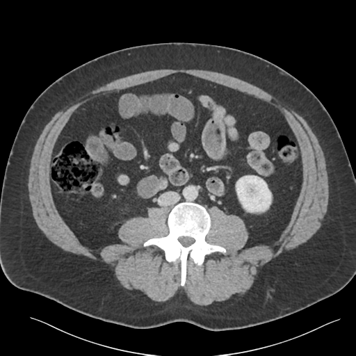 Adrenal cyst (Radiopaedia 45625-49777 Axial C+ portal venous phase 58).png