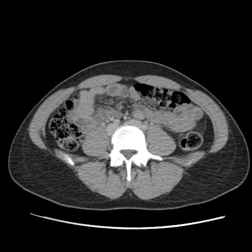 File:Adrenal cyst (Radiopaedia 64869-73813 Axial C+ portal venous phase 47).jpg