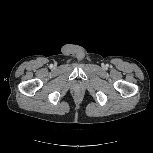 Adrenal cystic lymphangioma (Radiopaedia 83161-97534 Axial C+ portal venous phase 104).jpg