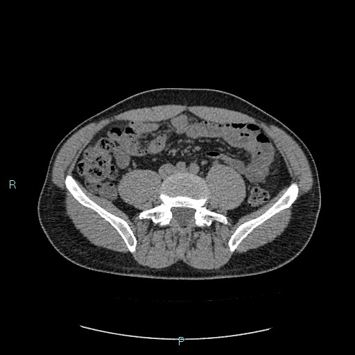 Adrenal cystic lymphangioma (Radiopaedia 83161-97534 Axial non-contrast 62).jpg