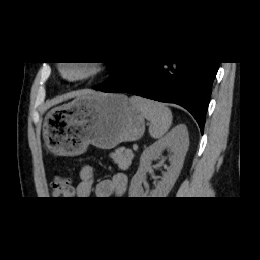 Adrenal gland trauma (Radiopaedia 81351-95079 Sagittal non-contrast 74).jpg