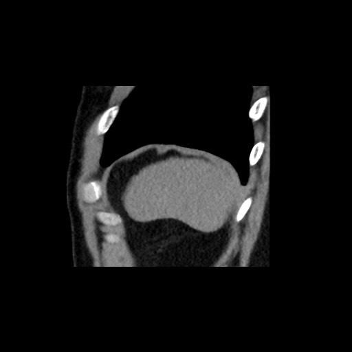 Adrenal gland trauma (Radiopaedia 81351-95079 Sagittal non-contrast 92).jpg
