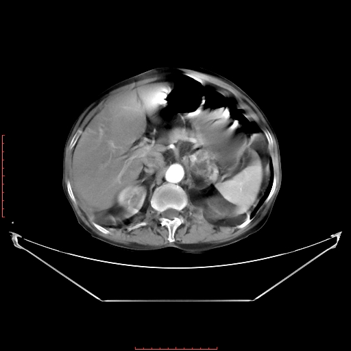 File:Adrenal hemangioma (Radiopaedia 68923-78668 Axial C+ arterial phase 27).jpg