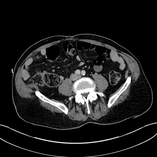 File:Adrenal lymphoma (Radiopaedia 73730-84529 Axial C+ portal venous phase 78).jpg