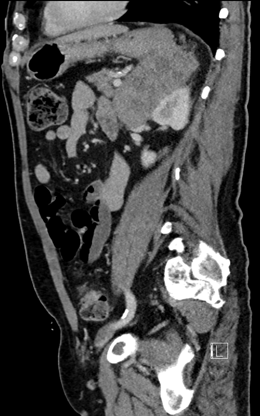 Adrenal lymphoma (Radiopaedia 73730-84529 Sagittal C+ portal venous phase 74).jpg