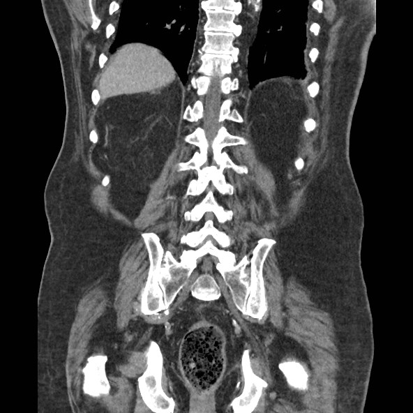 Adrenal lymphoma (Radiopaedia 84145-99415 Coronal C+ portal venous phase 70).jpg