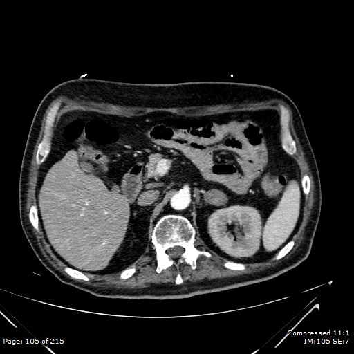 Adrenal metastasis (Radiopaedia 78425-91079 Axial C+ arterial phase 35).jpg