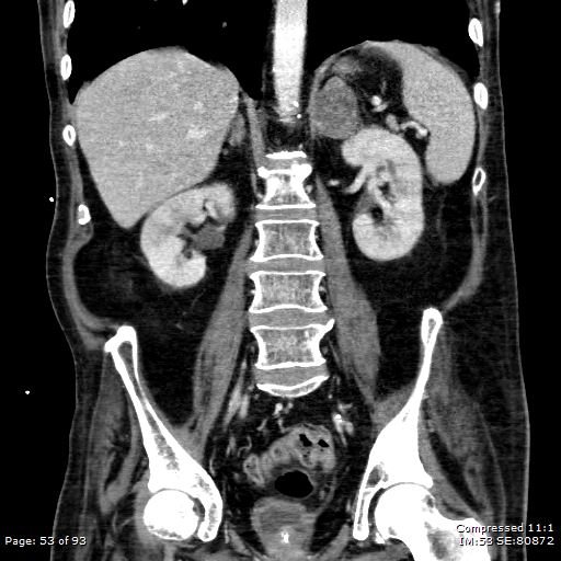 Adrenal metastasis (Radiopaedia 78425-91079 Sagittal C+ portal venous phase 40).jpg