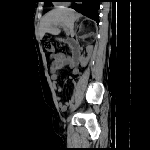 File:Adrenal myelolipoma (Radiopaedia 41843-44834 Sagittal non-contrast 15).jpg