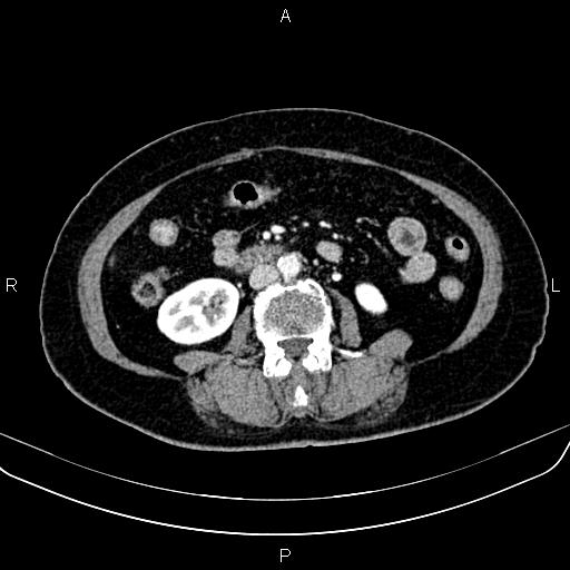 Adrenal myelolipoma (Radiopaedia 82742-96986 Axial renal cortical phase 93).jpg