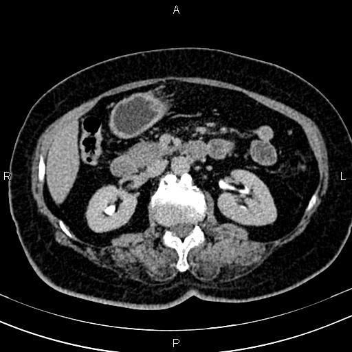 Adrenal myelolipoma (Radiopaedia 82742-96986 Axial renal excretory phase 62).jpg