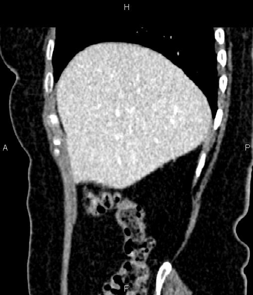 Adrenal myelolipoma (Radiopaedia 82742-96986 Sagittal renal cortical phase 27).jpg