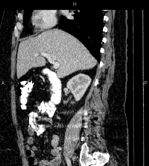 Adrenal myelolipoma (Radiopaedia 84319-99617 Sagittal renal cortical phase 34).jpg