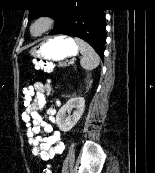 Adrenal myelolipoma (Radiopaedia 84319-99617 Sagittal renal cortical phase 71).jpg
