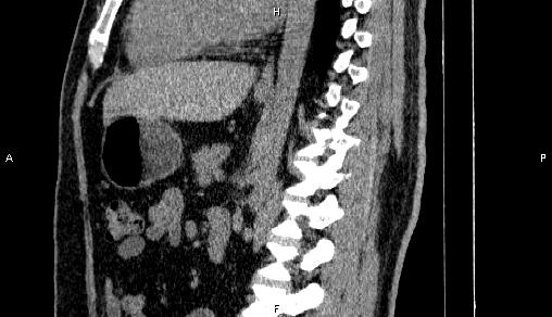 Adrenal myelolipoma (Radiopaedia 84321-99619 Sagittal non-contrast 61).jpg