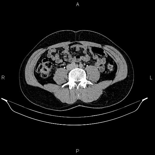 Adrenal myelolipoma (Radiopaedia 87794-104246 Axial renal excretory phase 61).jpg