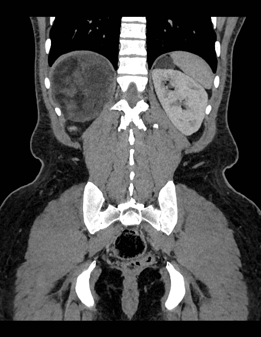 Adrenal myelolipoma - bilateral (Radiopaedia 74805-85810 Coronal C+ portal venous phase 91).jpg