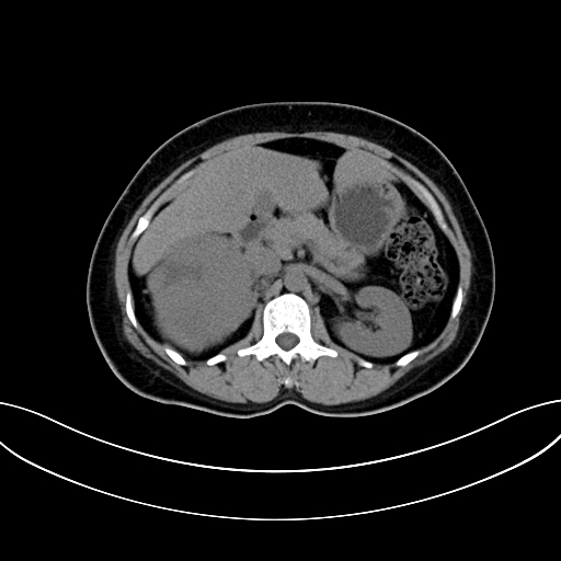 Adrenocortical carcinoma (Radiopaedia 87281-103569 Axial non-contrast 34).jpg