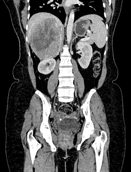 Adrenocortical carcinoma (Radiopaedia 87281-103569 Coronal C+ portal venous phase 74).jpg