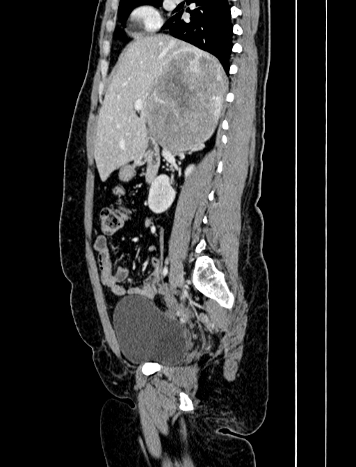Adrenocortical carcinoma (Radiopaedia 87281-103569 Sagittal C+ portal venous phase 108).jpg