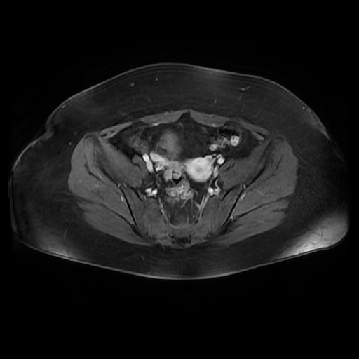 File:Adult granulosa cell tumor of the ovary (Radiopaedia 64991-73953 axial-T1 Fat sat post-contrast dynamic 68).jpg