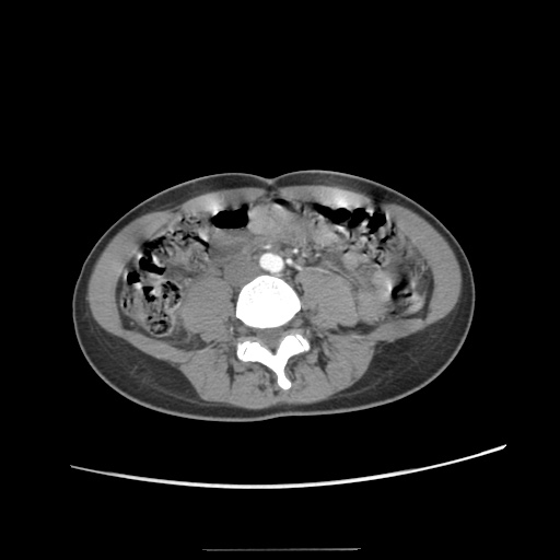 Adult polycystic kidney disease (Radiopaedia 48845-53876 Axial renal cortical phase 44).jpg