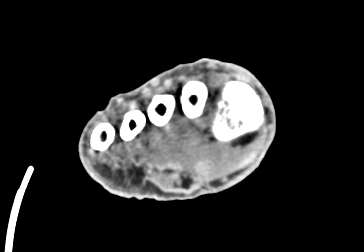 Advanced osteomyelitis due to open metatarsal fracture (Radiopaedia 83891-99095 Axial non-contrast 32).jpg