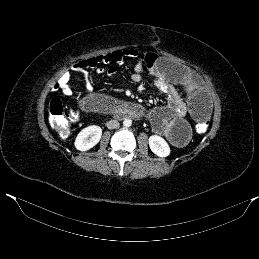 Afferent loop syndrome - secondary to incarcerated trocar site hernia (Radiopaedia 82959-97305 Axial C+ portal venous phase 116).jpg