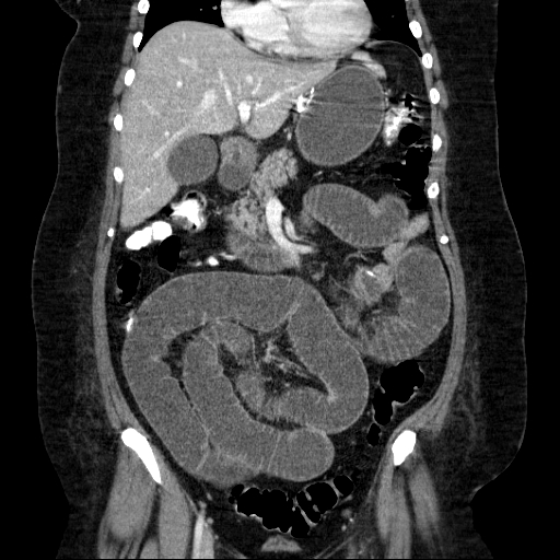 File:Afferent loop syndrome - secondary to incarcerated trocar site hernia (Radiopaedia 82959-97305 Coronal C+ portal venous phase 68).jpg