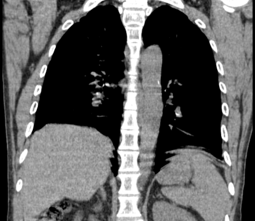 Airway foreign body in adult (Radiopaedia 85907-101779 Coronal liver window 177).jpg