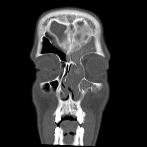 File:Allergic fungal sinusitis (Radiopaedia 29086-29455 Coronal bone window 17).jpg