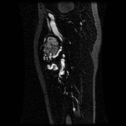 Alveolar soft part sarcoma (Radiopaedia 64501-73678 D 60).jpg