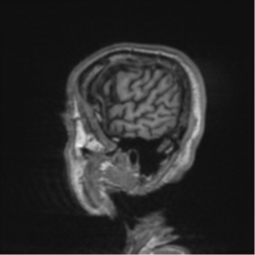 File:Alzheimer's disease- with apraxia (Radiopaedia 54763-61011 Sagittal T1 64).png