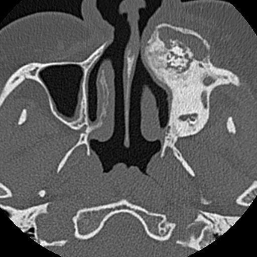 File:Ameloblastic fibro-odontoma (Radiopaedia 18843-18780 C 25).jpg