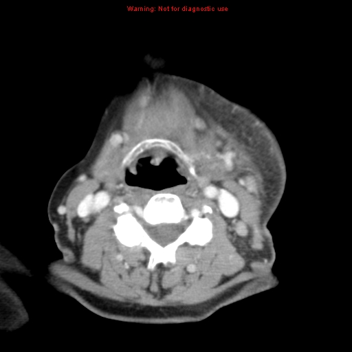 Ameloblastoma (Radiopaedia 27437-27631 A 57).jpg