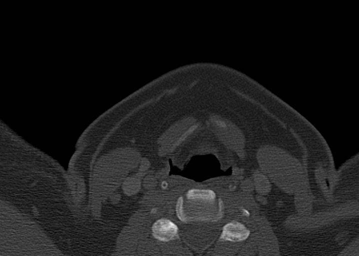 Ameloblastoma (Radiopaedia 38520-40623 D 49).png