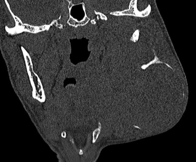 Ameloblastoma (Radiopaedia 51921-57766 Coronal bone window 156).jpg