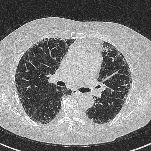 Amiodarone-induced pulmonary fibrosis (Radiopaedia 82355-96460 Axial lung window 32).jpg