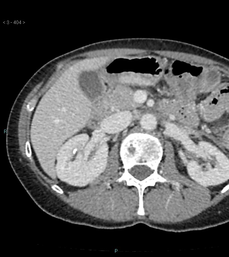 Ampulla of Vater metastasis (Radiopaedia 27820-28065 A 8).jpg