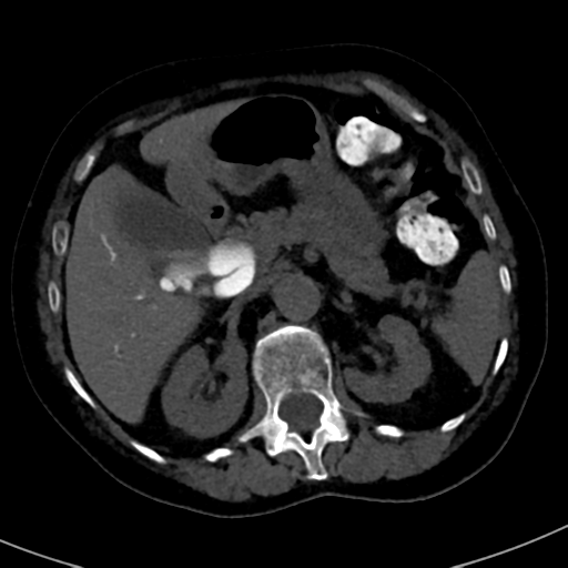 File:Ampullary adenocarcinoma (Radiopaedia 34013-35241 AXIAL THICK 28).png