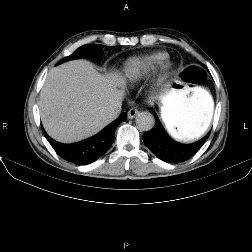 Ampullary adenocarcinoma (Radiopaedia 86093-102032 Axial C+ delayed 11).jpg