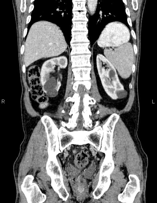 Ampullary adenocarcinoma (Radiopaedia 86093-102032 C 49).jpg