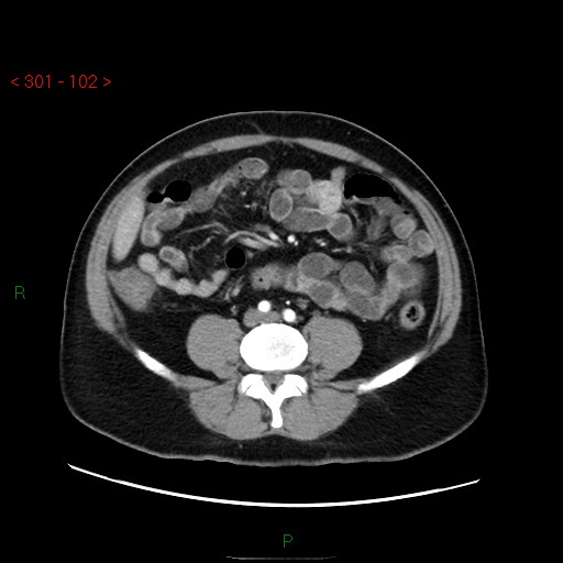Ampullary carcinoma (Radiopaedia 56396-63056 B 48).jpg
